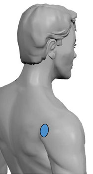 TENS Elektrodenanlage bei Schultergelenkschmerzen Schulterschmerzen